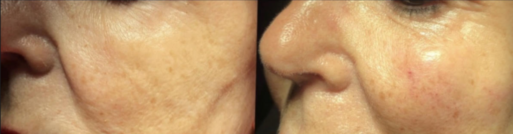 Fillers | The Art Of Skin Dermatology | Poughkeepsie, Ny