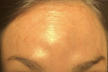 Botox | The Art Of Skin Dermatology | Poughkeepsie, Ny