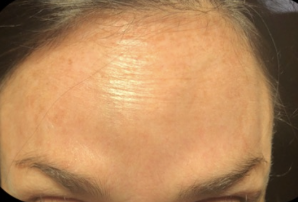 Botox | The Art Of Skin Dermatology | Poughkeepsie, Ny