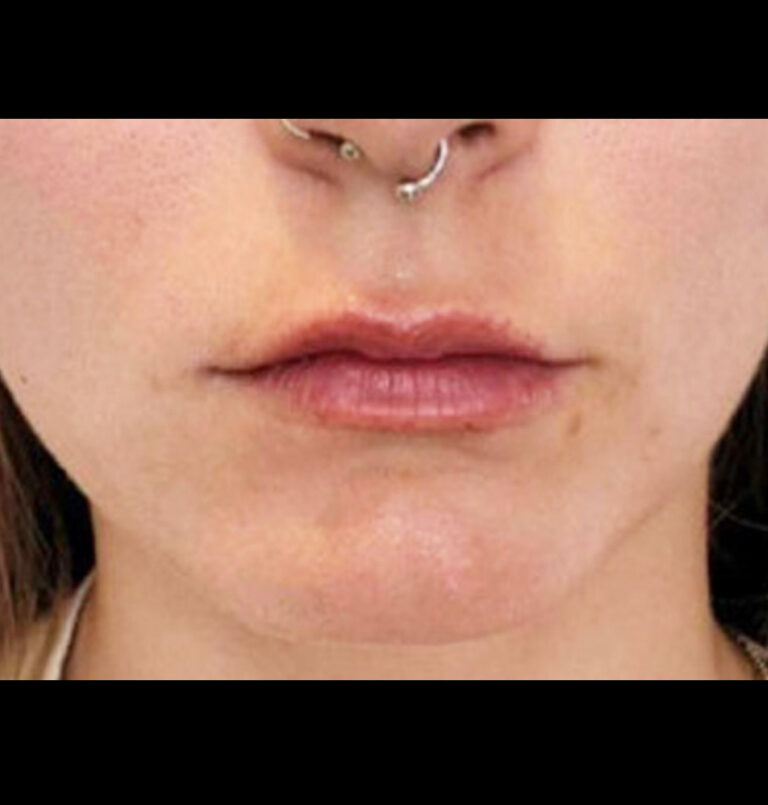 Close up of young woman's lips after lip filler