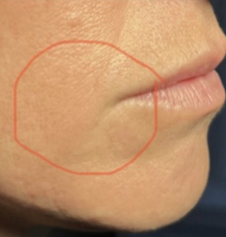 Close up of the corner of a person's mouth after redensity filler