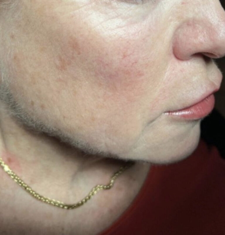 Close Up Of Woman'S Jawline After Ultherapy Treatment