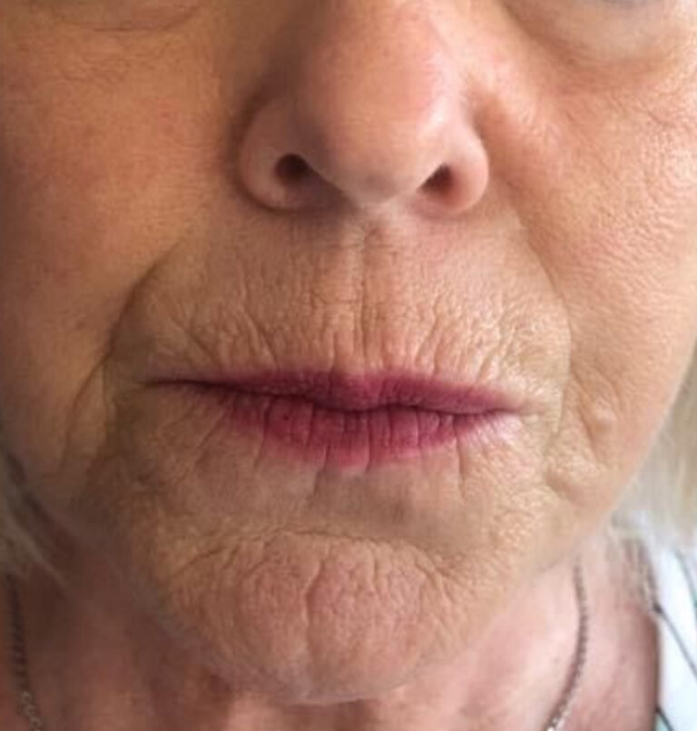 Close-up of older woman's mouth area before filler