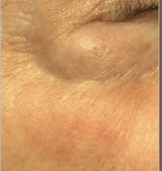 Laser | The Art Of Skin Dermatology | Poughkeepsie, Ny