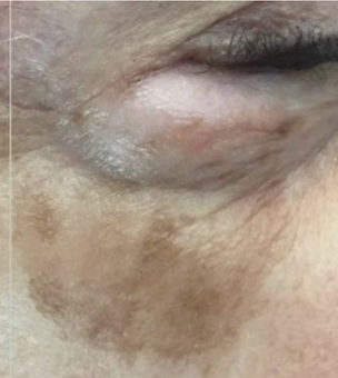 Laser | The Art Of Skin Dermatology | Poughkeepsie, Ny