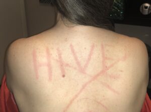 Hives