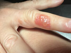 Allergic Contact Dermatitis