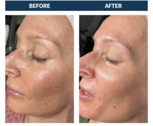 Microneedling