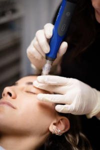 Microneedling