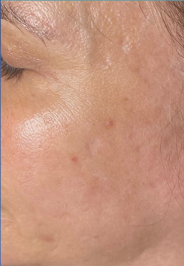 Microneedling | The Art of Skin Dermatology | Poughkeepsie, NY