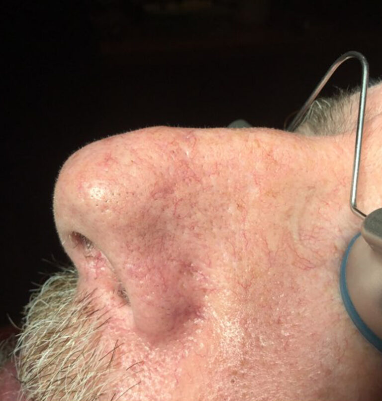 Close Up Of Man'S Nose After Laser Treatment