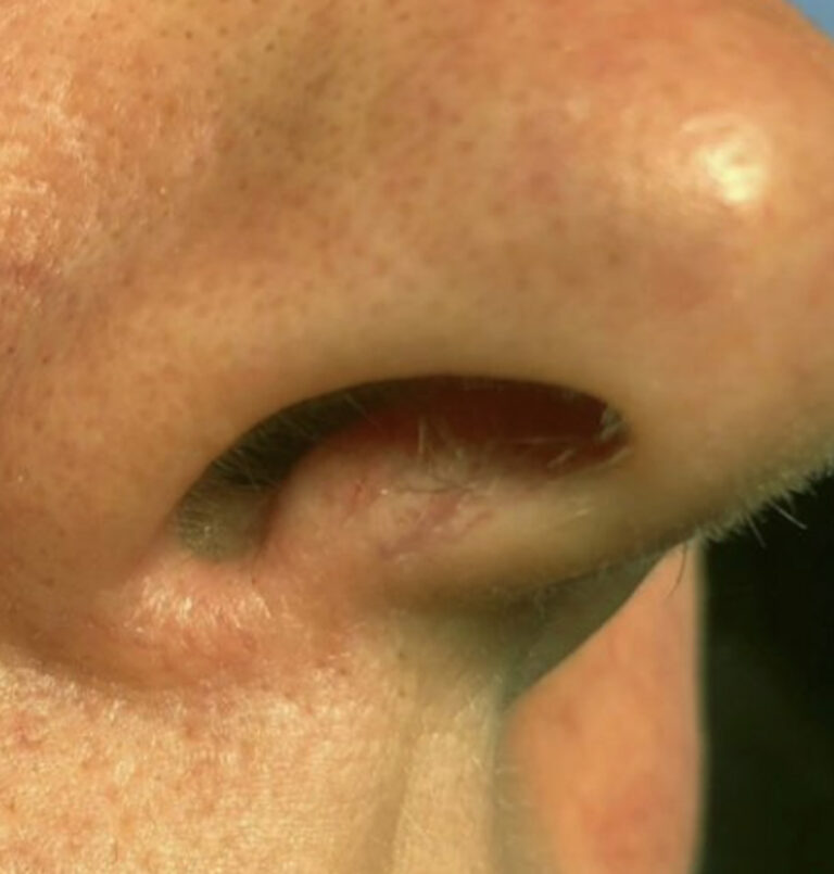 Close Up Of Person'S Nostril After Laser Treatment