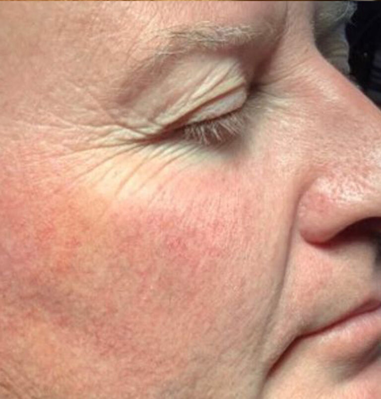 Red Laser | The Art Of Skin Dermatology | Poughkeepsie, Ny