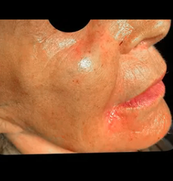 Before &Amp; After Gallery | The Art Of Skin Dermatology | Poughkeepsie, Ny