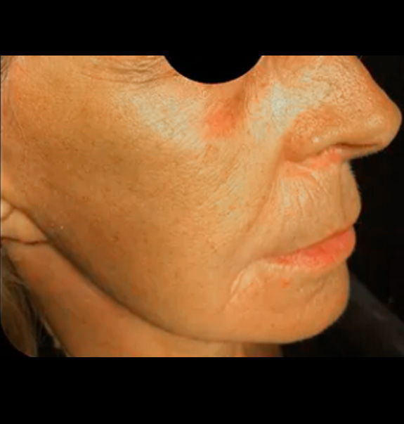 Before &Amp; After Gallery | The Art Of Skin Dermatology | Poughkeepsie, Ny