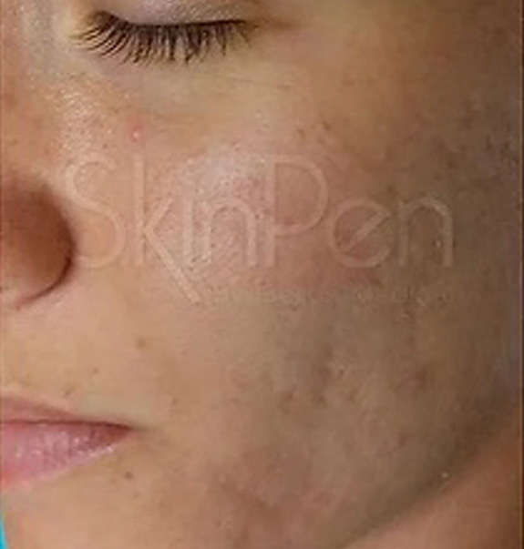 Before &Amp; After Gallery | The Art Of Skin Dermatology | Poughkeepsie, Ny