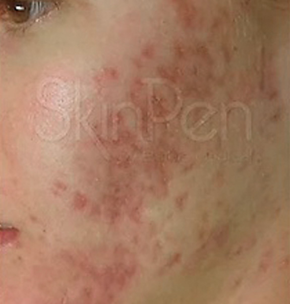 Before &Amp; After Gallery | The Art Of Skin Dermatology | Poughkeepsie, Ny