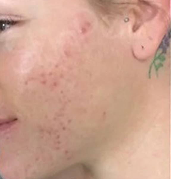 Before &Amp; After Gallery | The Art Of Skin Dermatology | Poughkeepsie, Ny