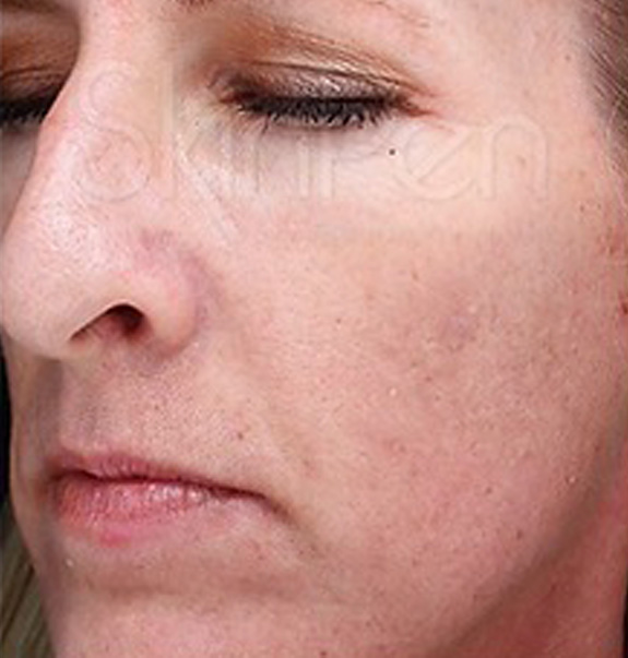 Before &Amp; After Gallery | The Art Of Skin Dermatology | Poughkeepsie, Ny