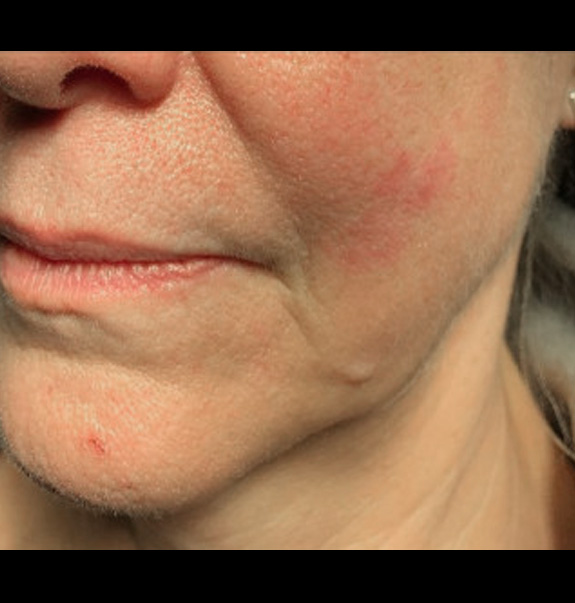 Before &Amp; After Gallery | The Art Of Skin Dermatology | Poughkeepsie, Ny