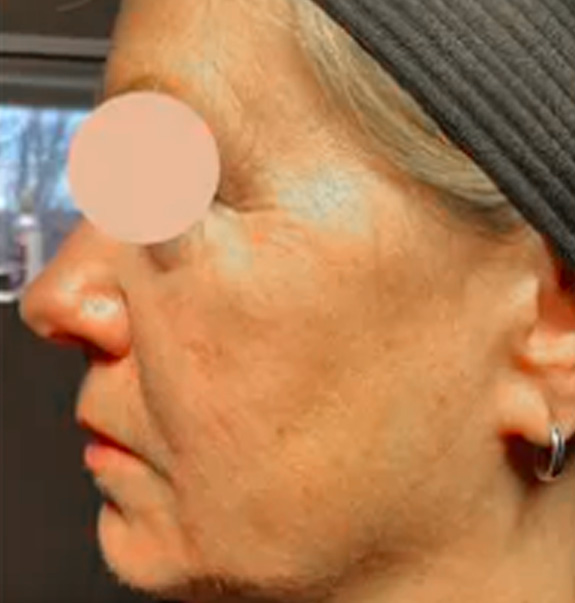 Before &Amp; After Gallery | The Art Of Skin Dermatology | Poughkeepsie, Ny