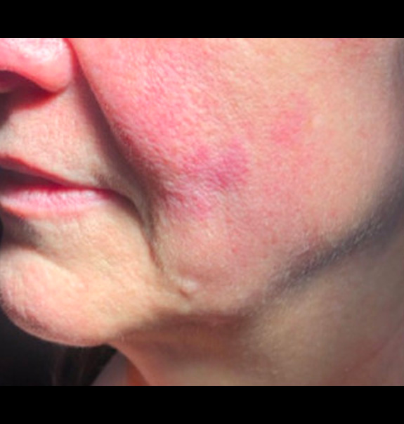 Before &Amp; After Gallery | The Art Of Skin Dermatology | Poughkeepsie, Ny