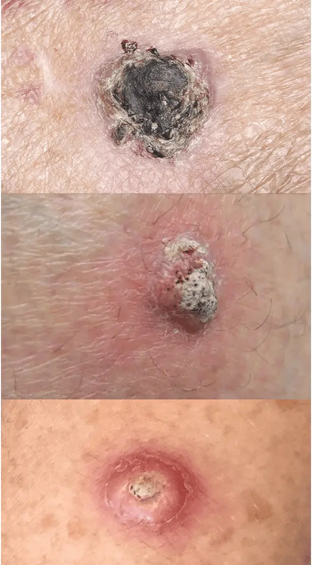 Squamous Cell Carcinomas | The Art Of Skin Dermatology | Poughkeepsie, Ny