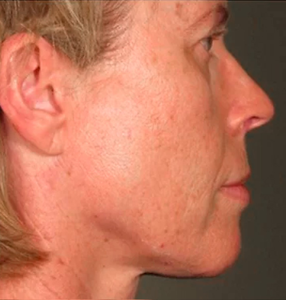 Before &Amp; After Gallery | The Art Of Skin Dermatology | Poughkeepsie, Ny