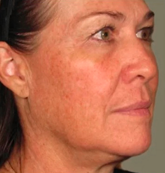 Before &Amp; After Gallery | The Art Of Skin Dermatology | Poughkeepsie, Ny