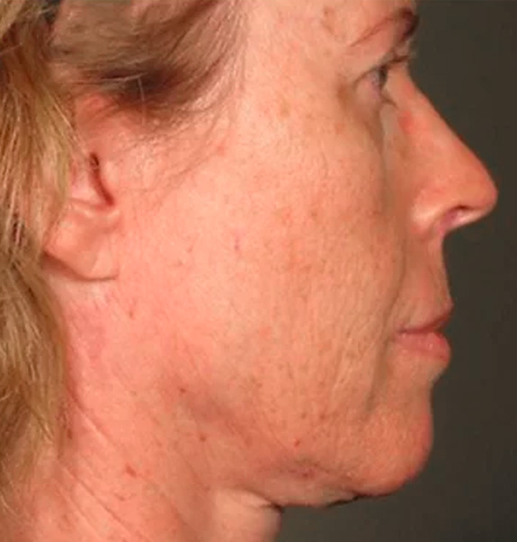 Before &Amp; After Gallery | The Art Of Skin Dermatology | Poughkeepsie, Ny