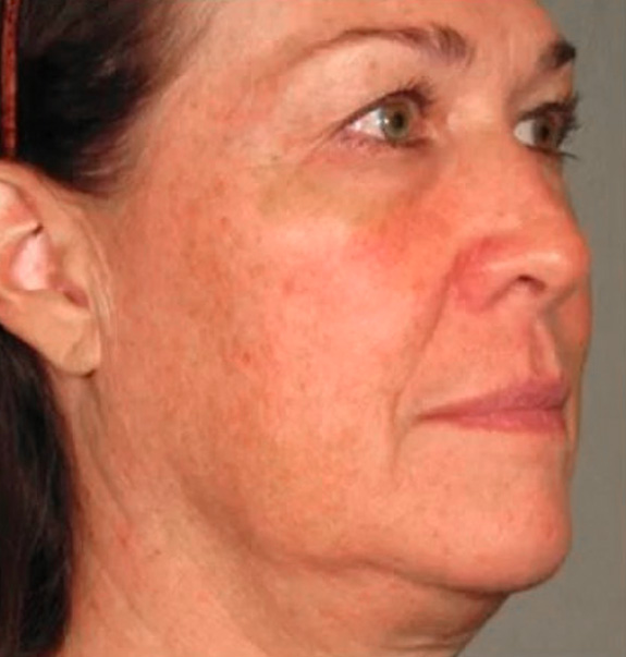 Before &Amp; After Gallery | The Art Of Skin Dermatology | Poughkeepsie, Ny