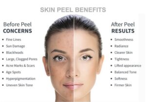 Chemical Peels