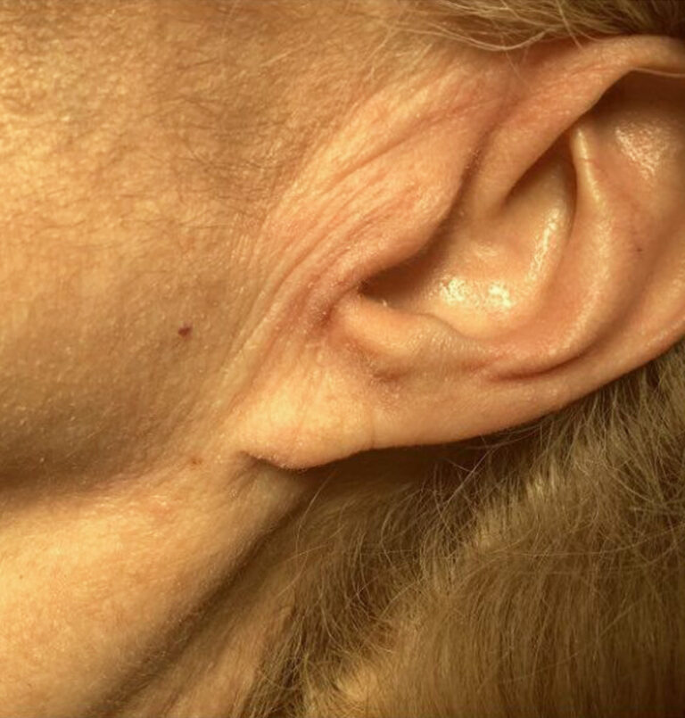 Ear Lobe Repair | The Art Of Skin Dermatology | Poughkeepsie, Ny