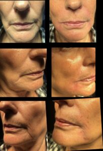 Before &Amp; After Gallery | The Art Of Skin Dermatology | Poughkeepsie, Ny