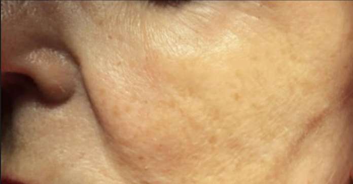 Before &Amp; After Gallery | The Art Of Skin Dermatology | Poughkeepsie, Ny