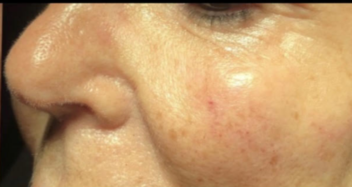 Before &Amp; After Gallery | The Art Of Skin Dermatology | Poughkeepsie, Ny