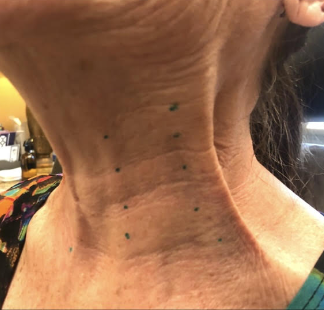 Before &Amp; After Gallery | The Art Of Skin Dermatology | Poughkeepsie, Ny