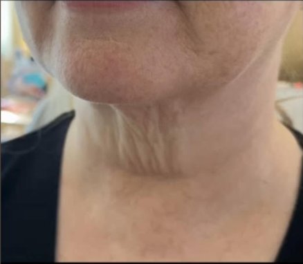 Before &Amp; After Gallery | The Art Of Skin Dermatology | Poughkeepsie, Ny