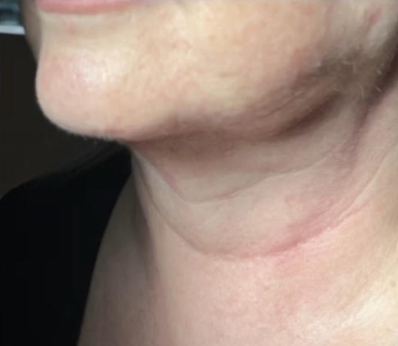 Before &Amp; After Gallery | The Art Of Skin Dermatology | Poughkeepsie, Ny