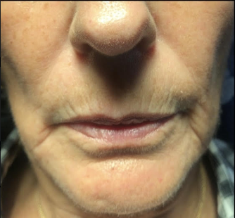 Before &Amp; After Gallery | The Art Of Skin Dermatology | Poughkeepsie, Ny