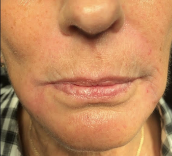 Before &Amp; After Gallery | The Art Of Skin Dermatology | Poughkeepsie, Ny