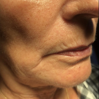 Before &Amp; After Gallery | The Art Of Skin Dermatology | Poughkeepsie, Ny