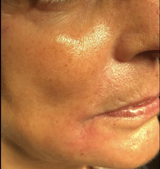 Before &Amp; After Gallery | The Art Of Skin Dermatology | Poughkeepsie, Ny