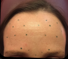 Before &Amp; After Gallery | The Art Of Skin Dermatology | Poughkeepsie, Ny