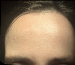 Before &Amp; After Gallery | The Art Of Skin Dermatology | Poughkeepsie, Ny