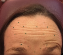 Before &Amp; After Gallery | The Art Of Skin Dermatology | Poughkeepsie, Ny