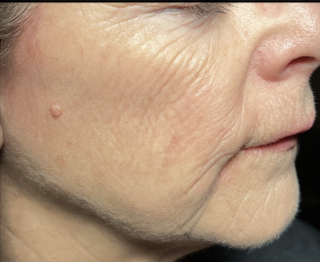 Sculptra | Before &Amp; After Gallery | The Art Of Skin Dermatology | Poughkeepsie, Ny