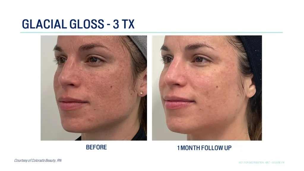 Glacial Rx At Art Of Skin