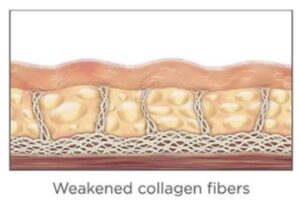 Ultherapy in NY & CT