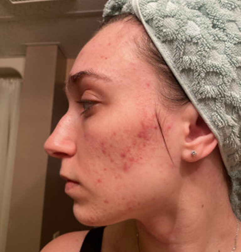 Acne | The Art of Skin Dermatology | Poughkeepsie, NY